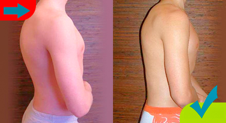 ზურგის კორსეტი